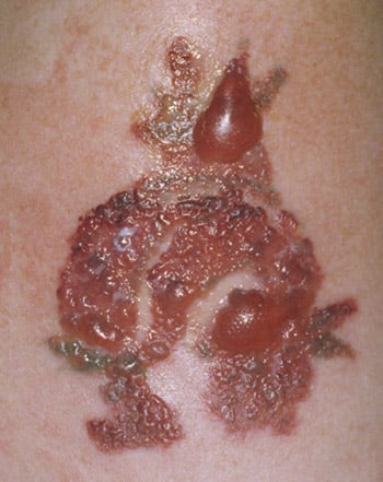  Signs-of -an-infizierten- tattoo 