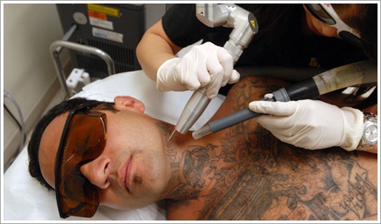 How to go about getting a tattoo removed design, idea 3